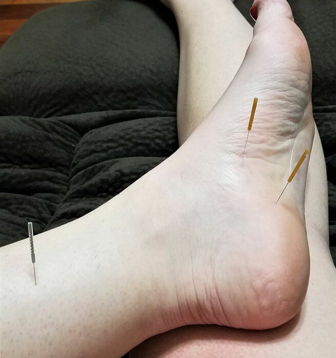 Intramuscular Electrical Stimulation for Ankle Pain, Dry needling with  intramuscular electrical stimulation for ankle pain. A lot of times, ankle  pain can be caused by other areas. In this case, tightness